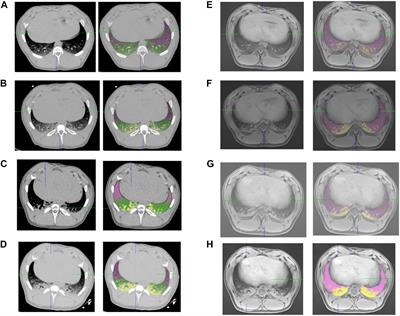 Validation of MRI for Volumetric Quantification of Atelectasis in the Perioperative Period: An Experimental Study in Swine